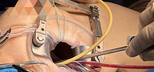 Уникальные операции в ЯОКБ спасли жизни двух пациентов